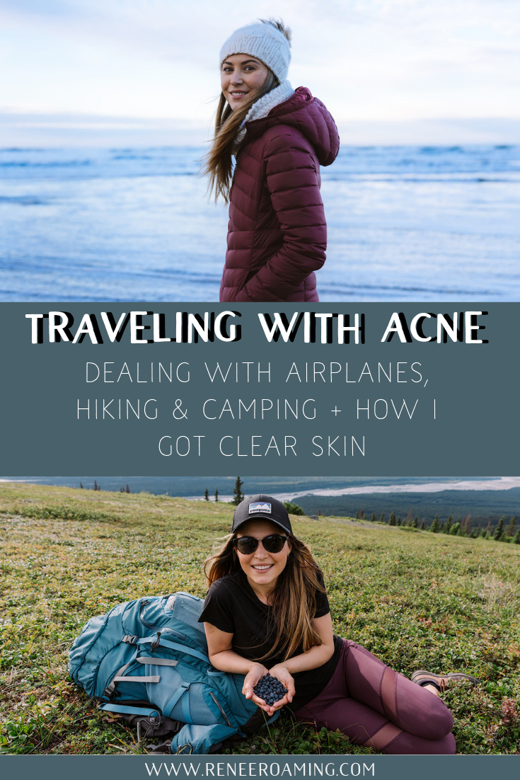 Traveling with Acne - Dealing with Airplanes, Hiking and Camping + How I Got Clear Skin - Renee Roaming